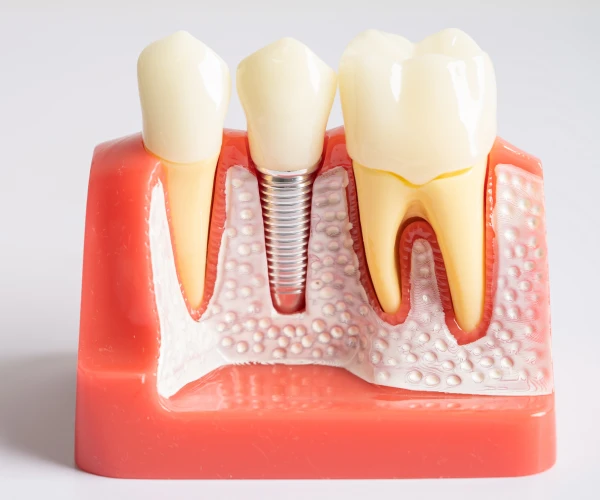 implantaci&oacute;n de dientes