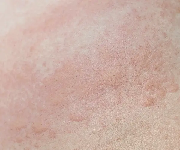 reacci&oacute;n de urticaria por estr&eacute;s