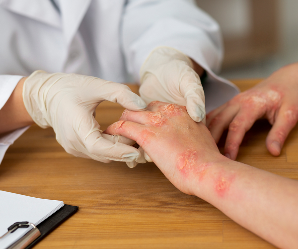 reacci&oacute;n de urticaria por estr&eacute;s