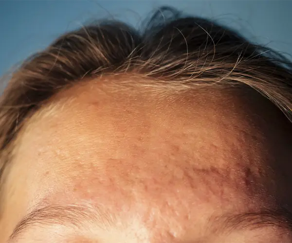 dermatitis seborreica en el rostro