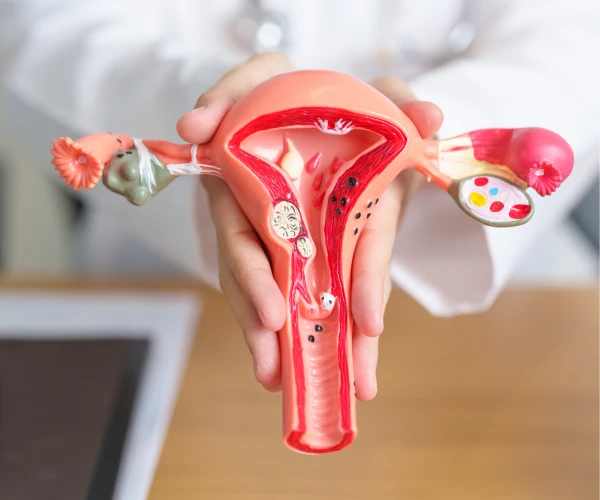 sindrome de ovario poliquistico